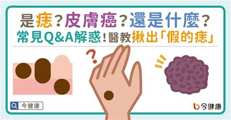 左手臂突然長痣|是痣or皮膚癌？醫「1張圖秒對照」 長這2部位最危險